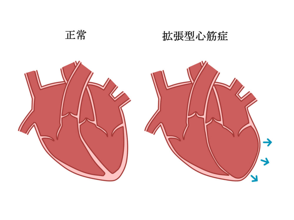 拡張型心筋症
