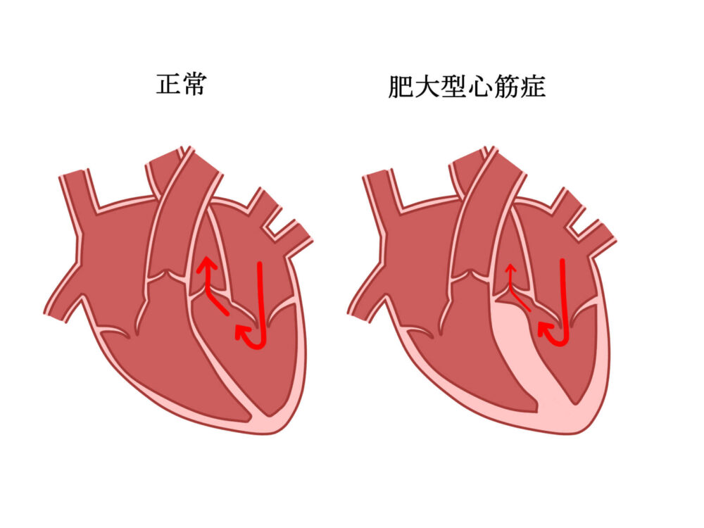 肥大型心筋症