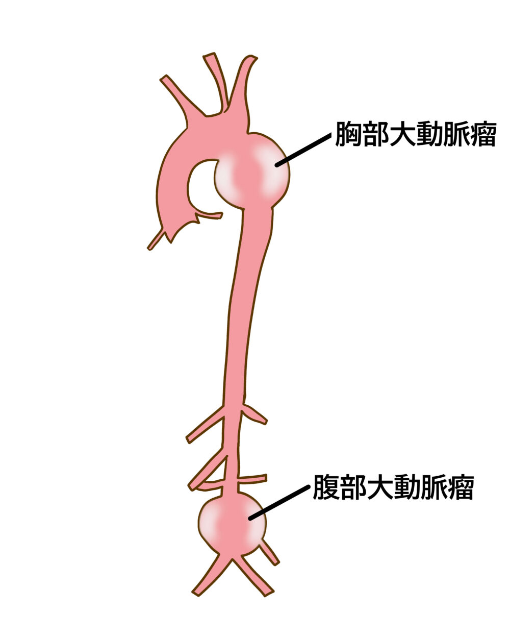 大動脈瘤