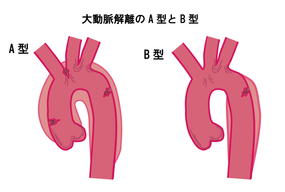 大動脈解離