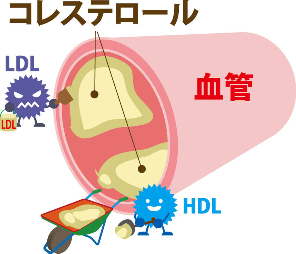 脂質異常症とは