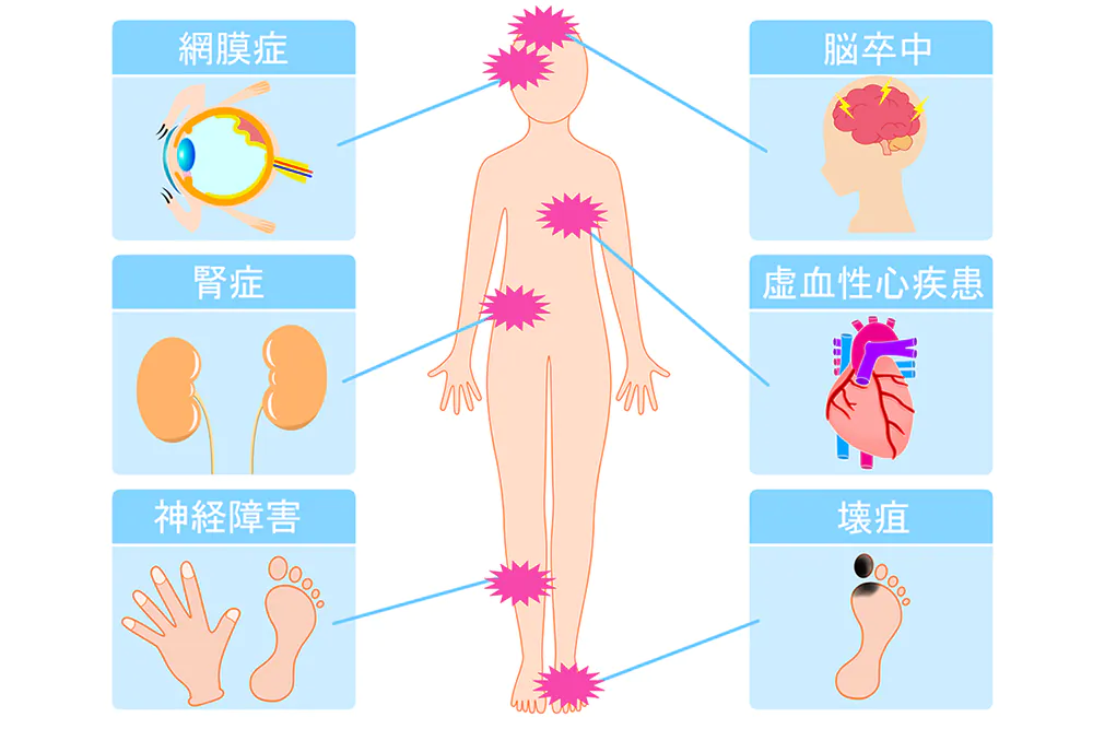 糖尿病は、特に合併症の多い生活習慣病