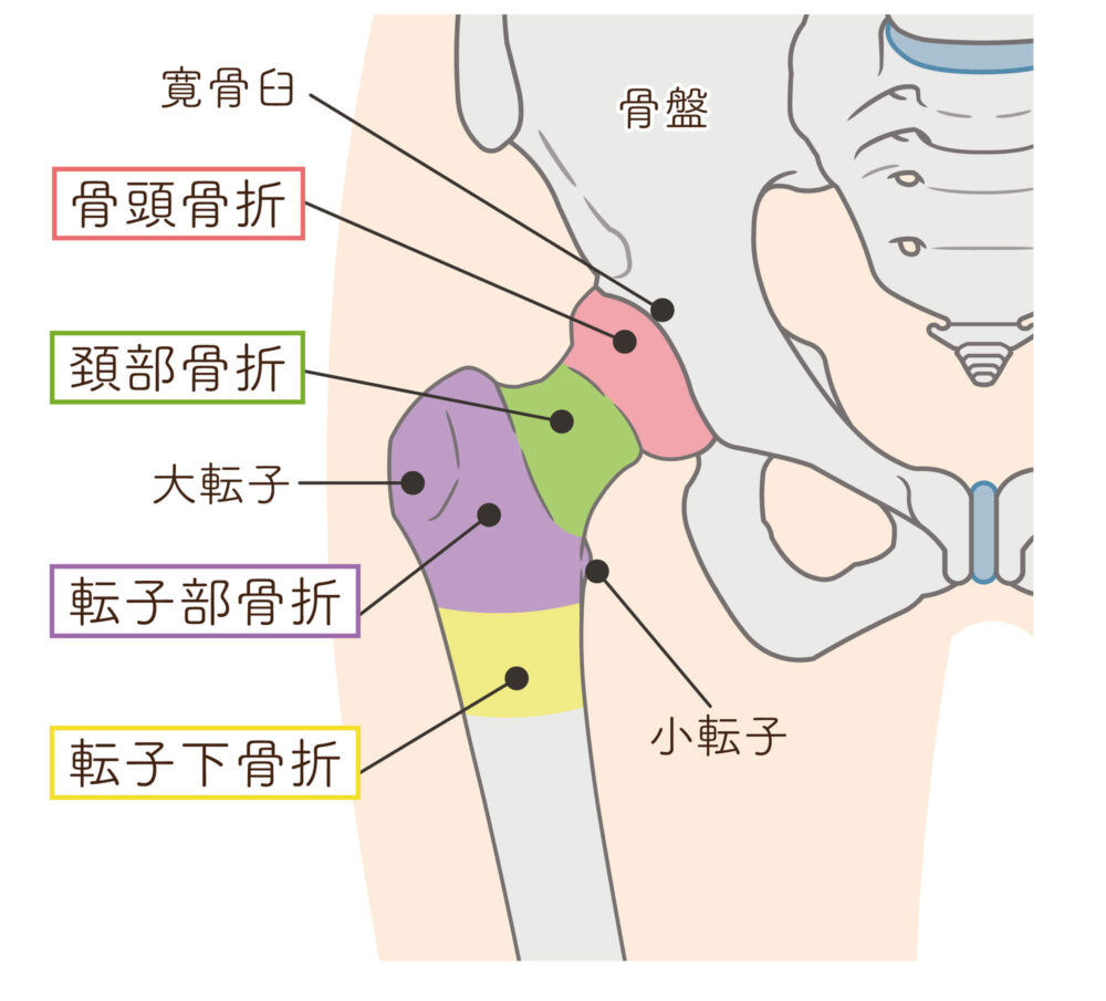 大腿骨頚部骨折とは