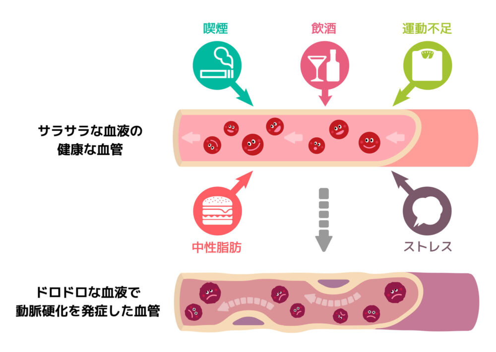 心筋梗塞の原因