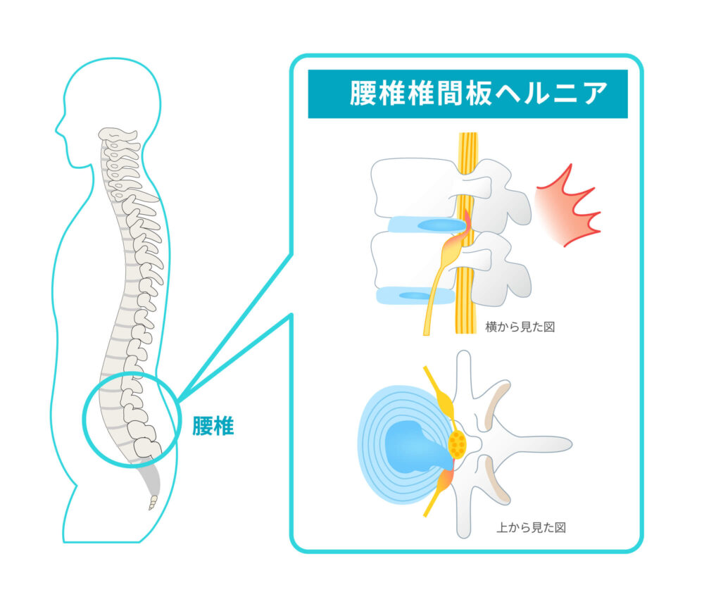 腰椎椎間板ヘルニアになるしくみ