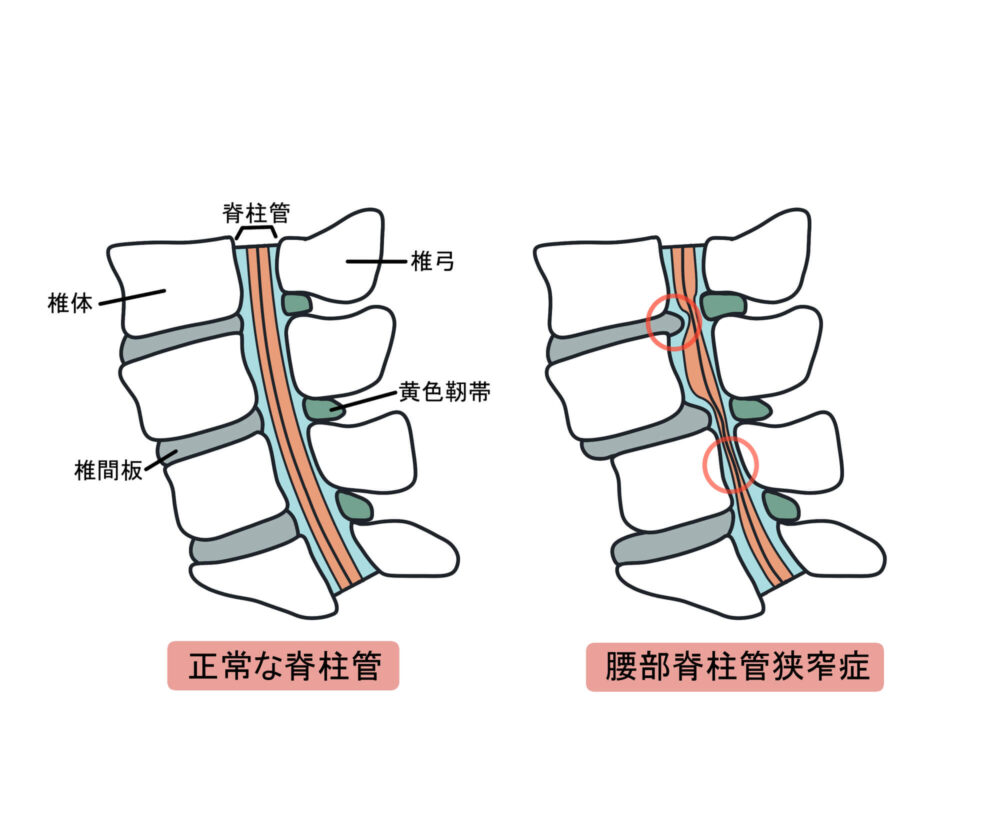 歩行障害などを引き起こす腰部脊柱管狭窄症とは